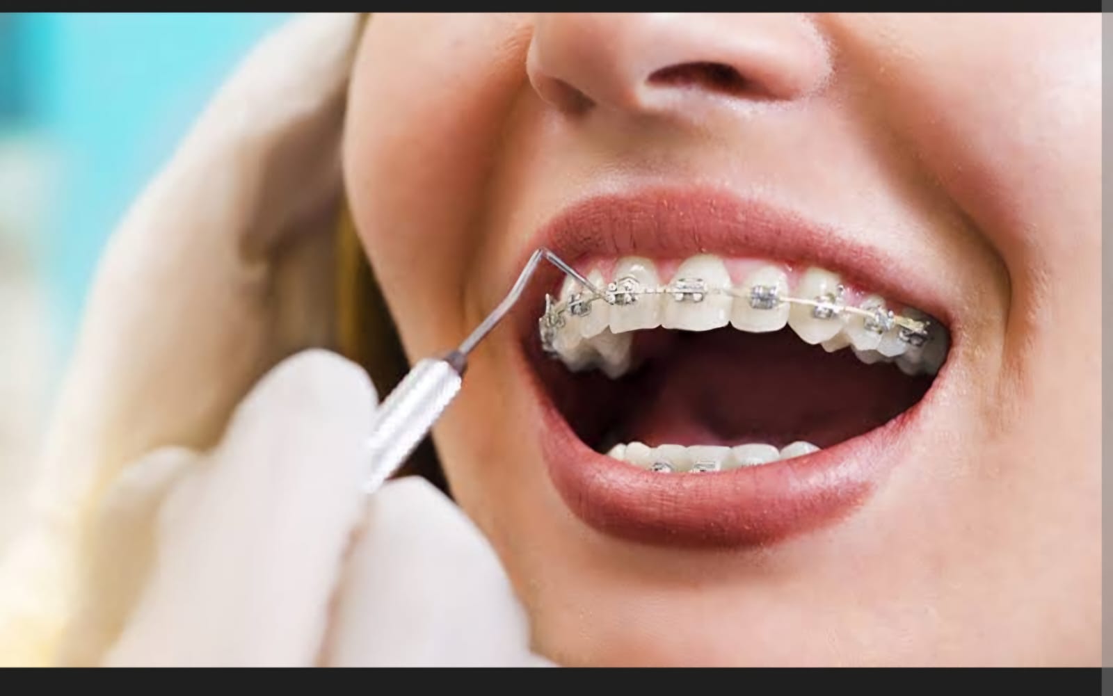 Patient with braces undergoing orthodontic treatment