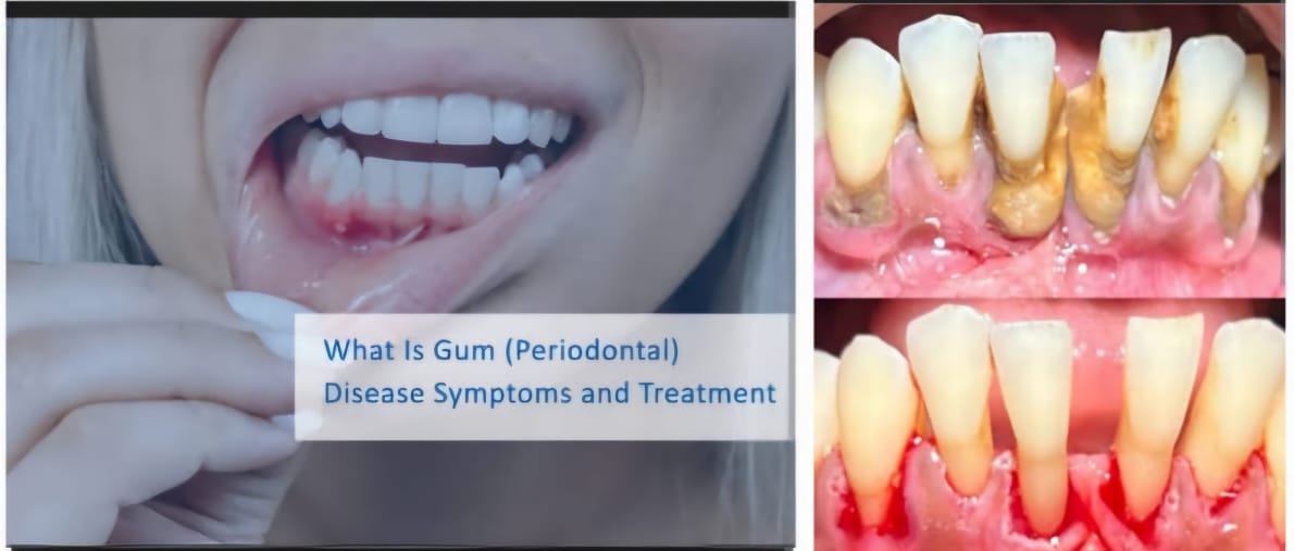 Image showing symptoms and effects of periodontal disease